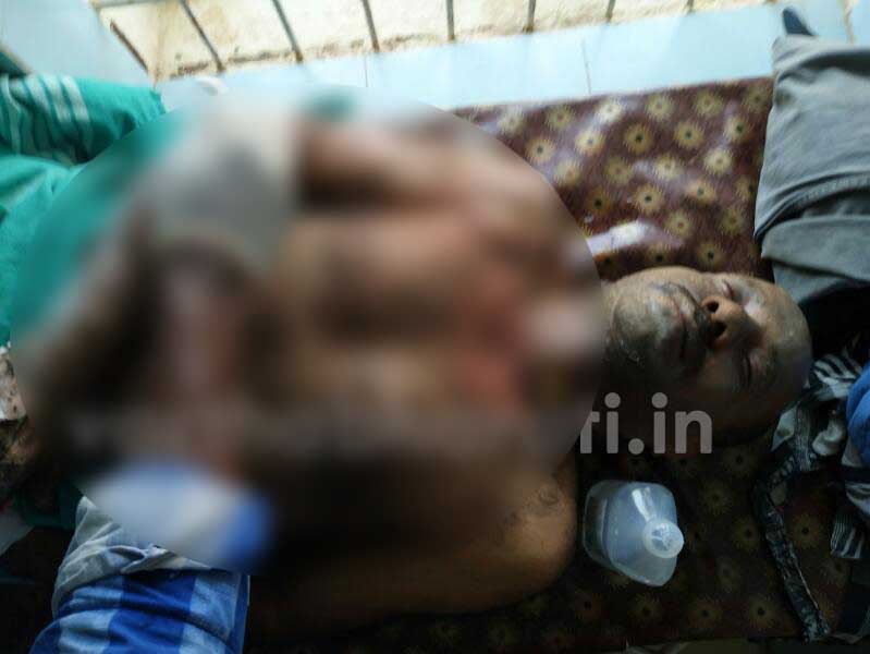 ವಿದ್ಯುತ್ ಶಾಕ್ ಸರ್ಕ್ಯೂಟ್: ಇಬ್ಬರು ಮೆಸ್ಕಾಂ ಸಿಬ್ಬಂದಿಗೆ ಗಂಭೀರ ಗಾಯ